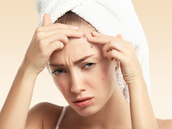 Remédio para acne: saiba como tratar esse problema