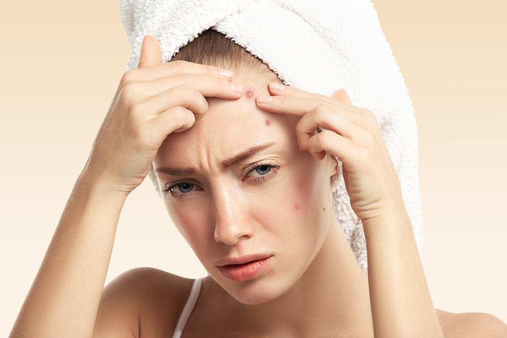 Remédio para acne: saiba como tratar esse problema