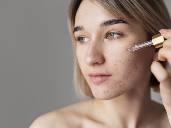 Medicamento para acne: o que considerar antes de iniciar um tratamento manipulado?