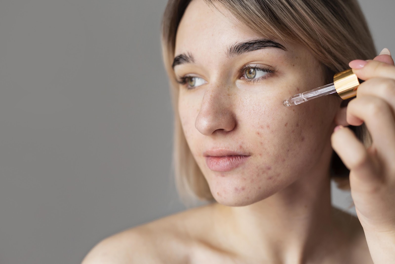 Medicamento para acne: o que considerar antes de iniciar um tratamento manipulado?