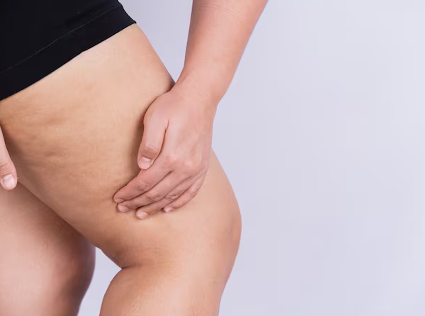 O que pode ajudar a reduzir a aparência da celulite de forma natural?