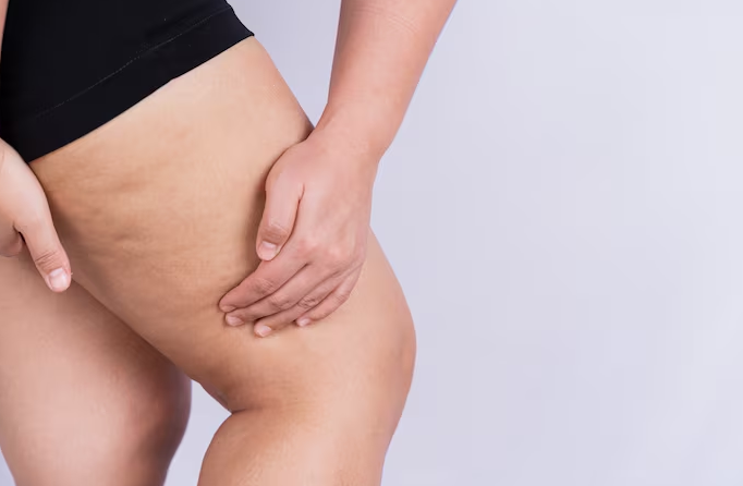 O que pode ajudar a reduzir a aparência da celulite de forma natural?